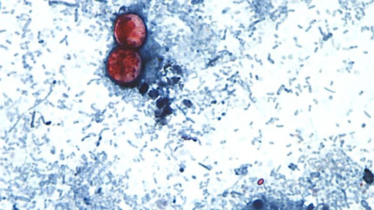 cyclosporiasis intestinal infection